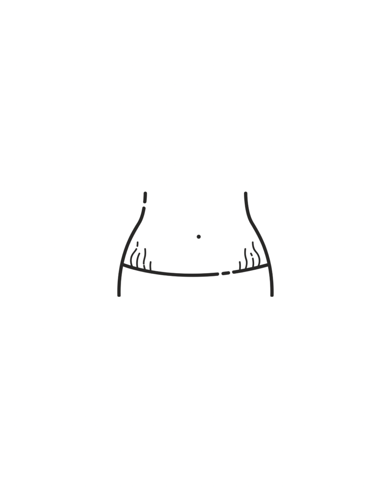 Small Area Stretch Marks/ Burns