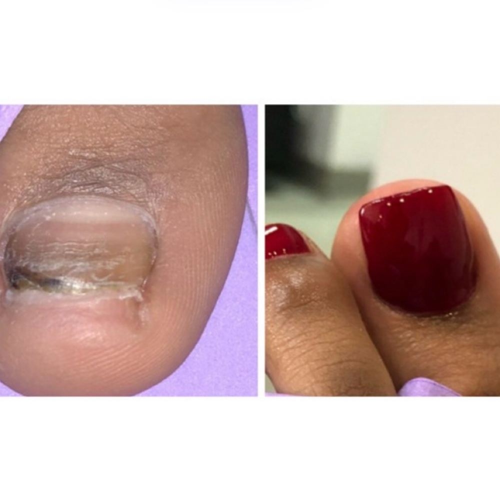 BUILDER ON BIG TOE at Everything Nails in Solon, OH