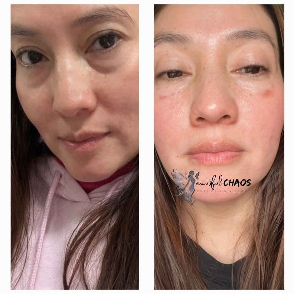 Anti-Aging Eye Treatment