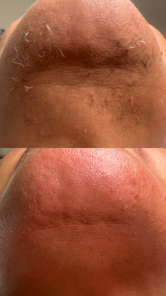 Chin Wax at J Esthetics in Homewood, IL