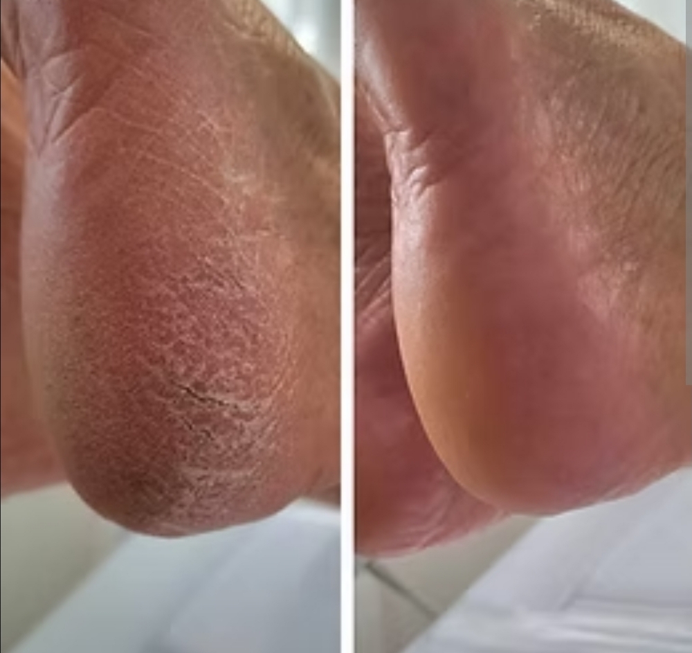 Callus Removal at SKIN AND NAILS BY MALLORY in Springfield, OH
