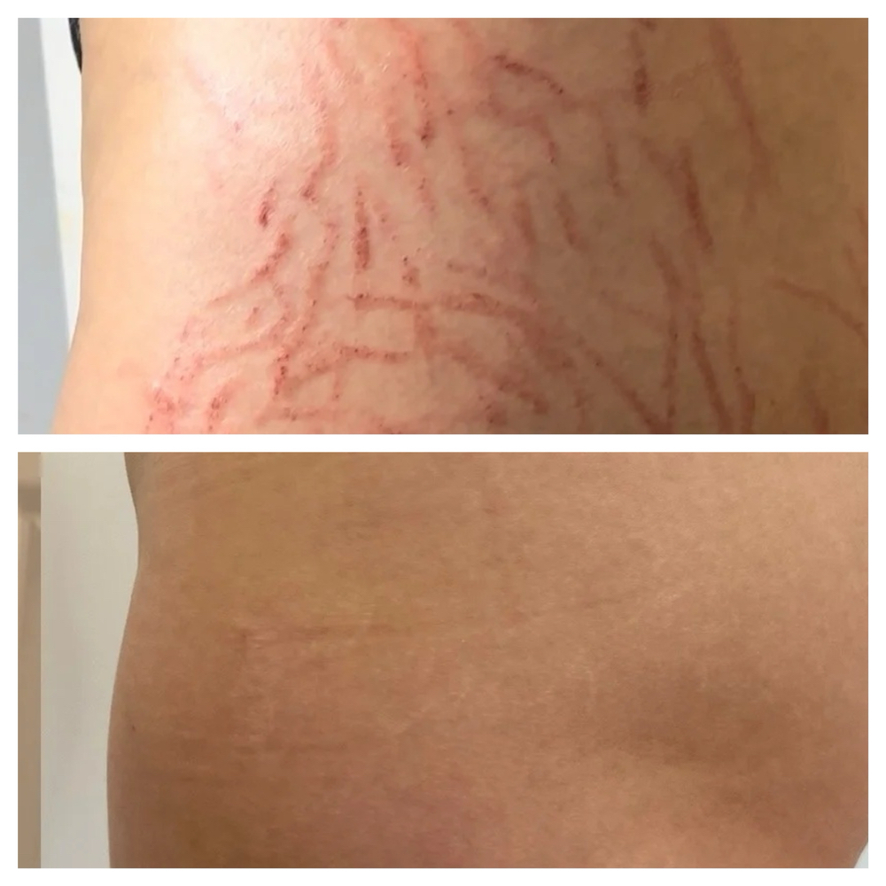 “ISR”-Inkless Scar Revision