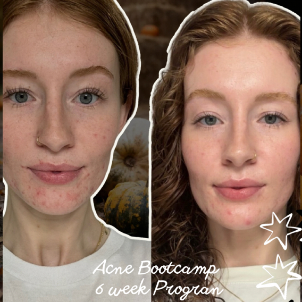 Acne Healing Bootcamp-6 Week Series at HydratedXHoney in Covington, GA