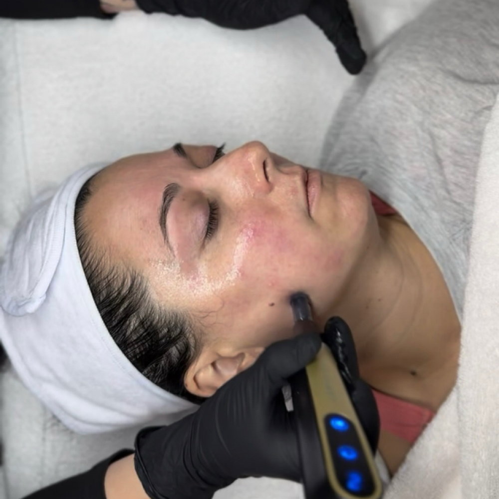 Nano Infusion at Mugshot Skincare in Omaha, NE