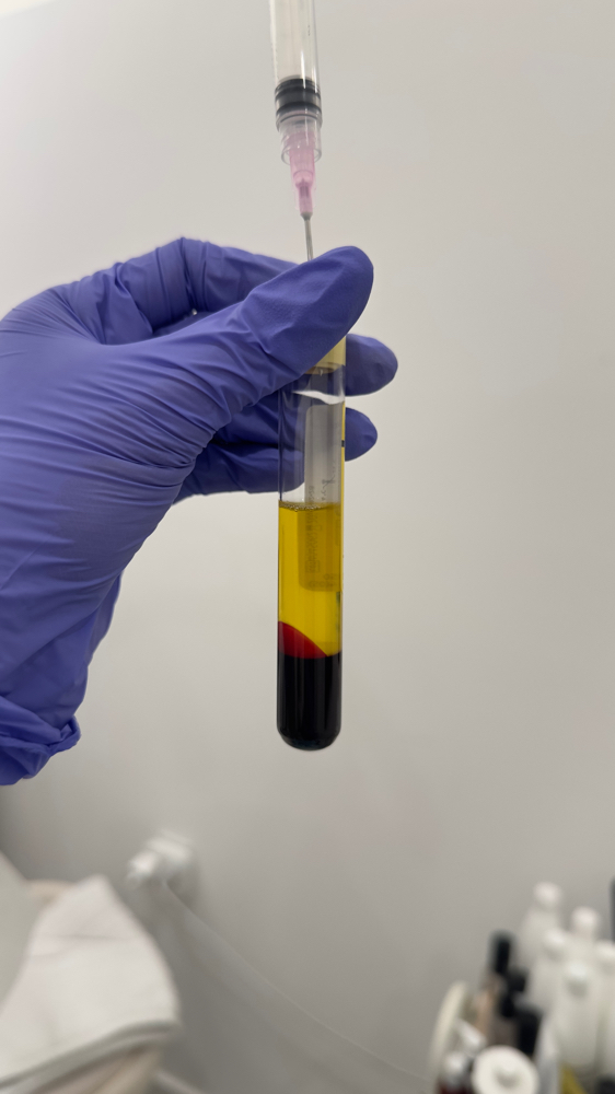 PRP (Platelet Rich Plasma)