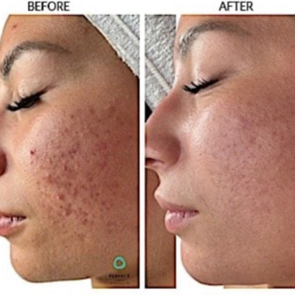 DermaPeel at Beauty And Body in San Dimas, CA