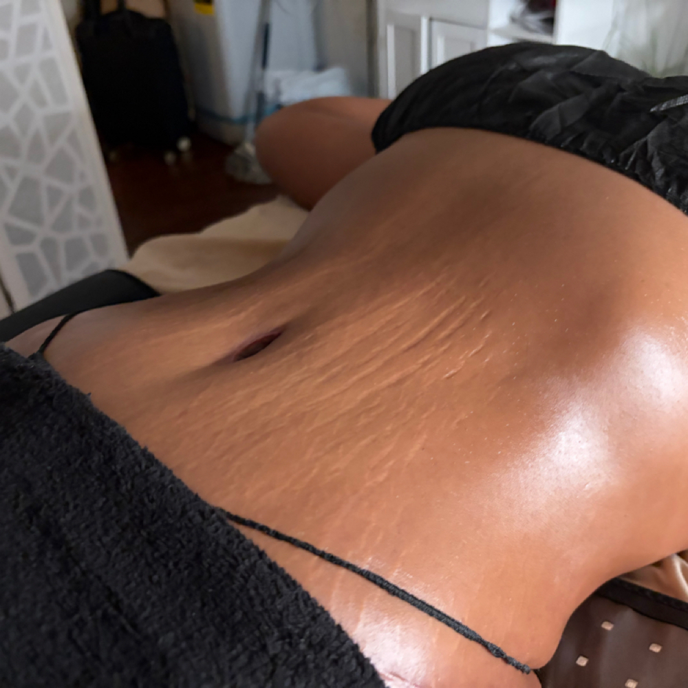 Post op lymphatic stage 1 at REVIVE THERAPEUTIC MASSAGE SPA in Fort Myers, FL