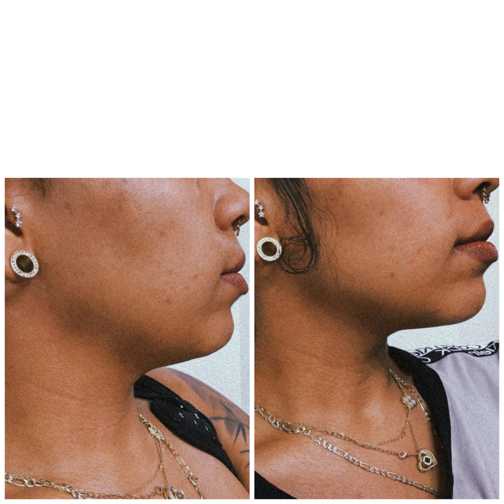 RF Double Chin Lipo