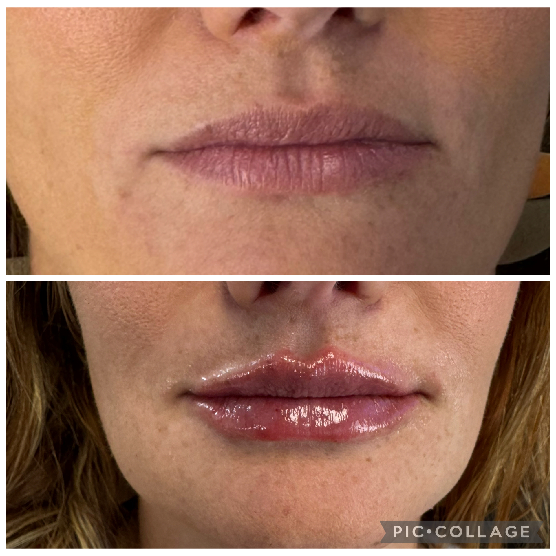 Lip Filler with Versa Lips