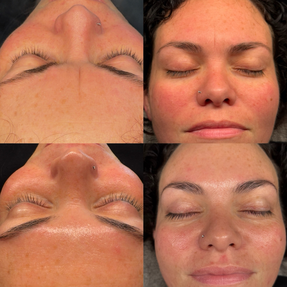 Oxygen Facial Series Of 6