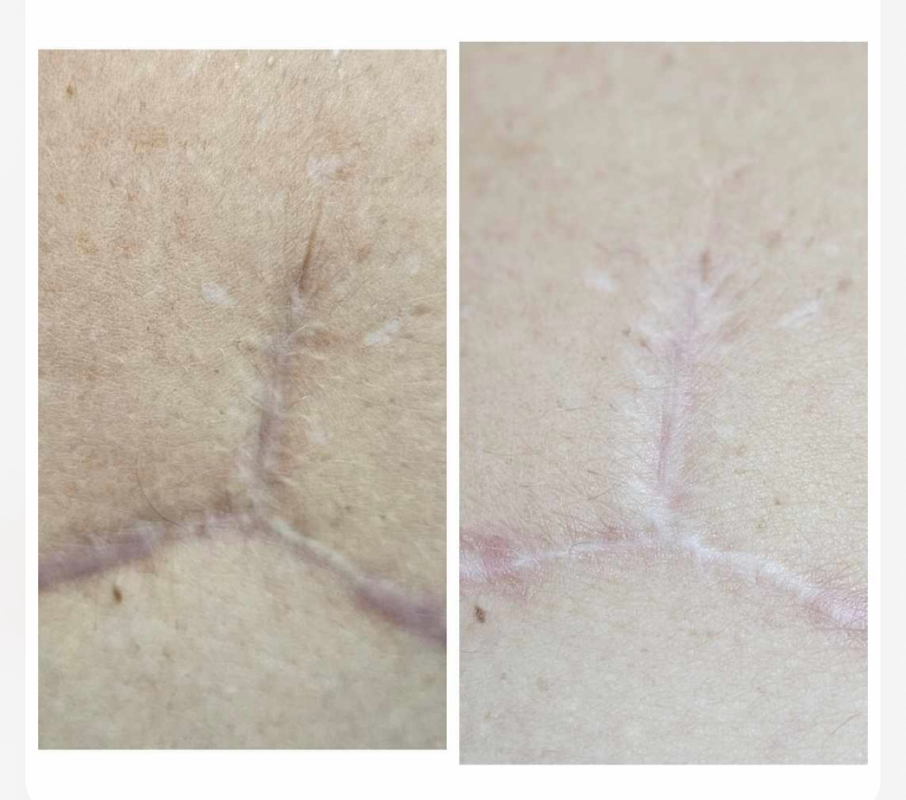 Scar Lightening Treatment