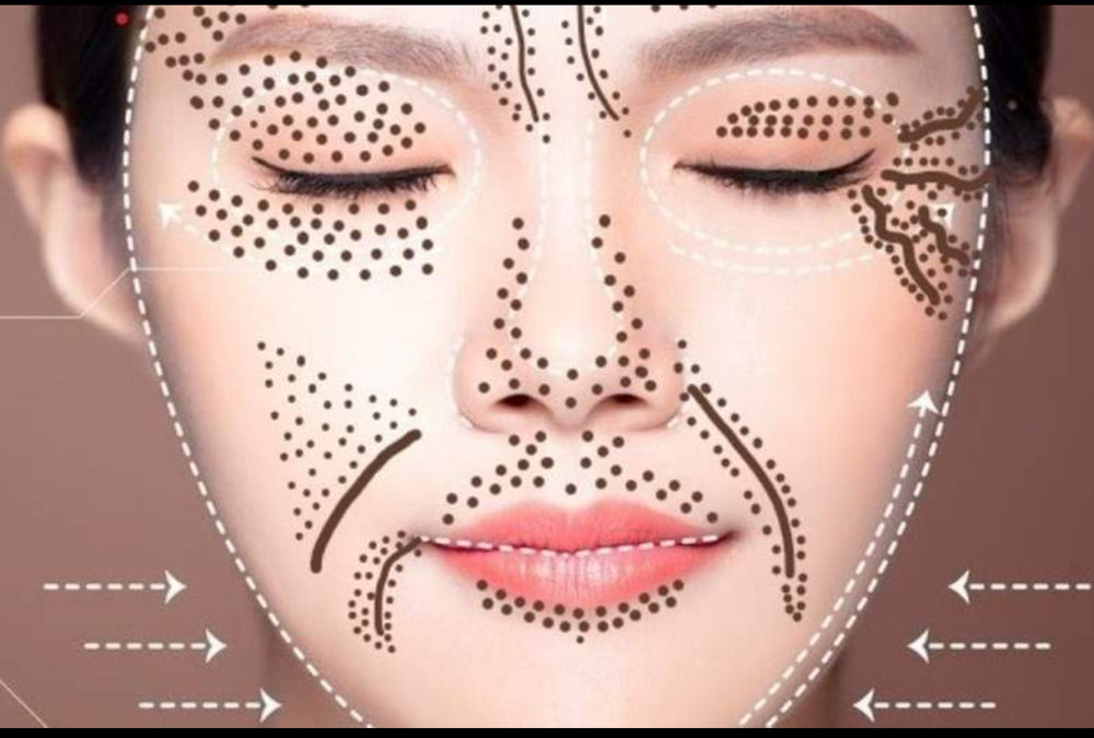 Fibroblast(Skin Tightening)