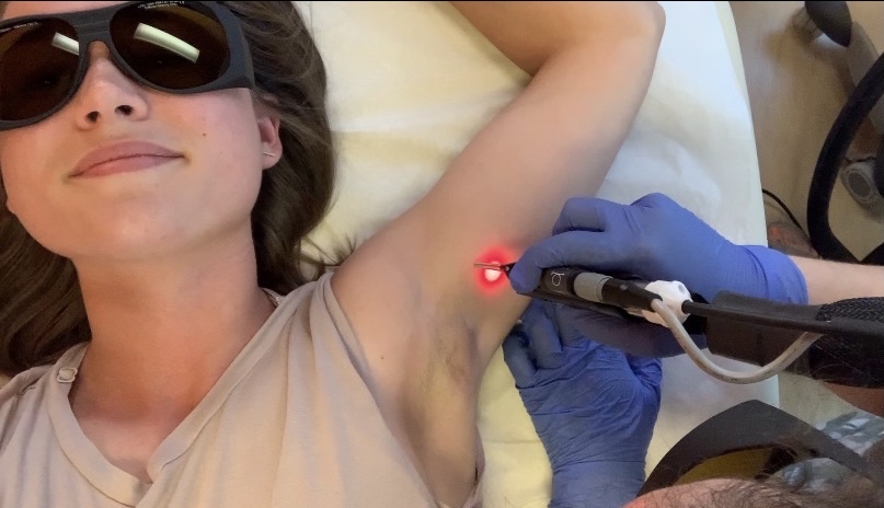 Per Session - Laser Hair Removal