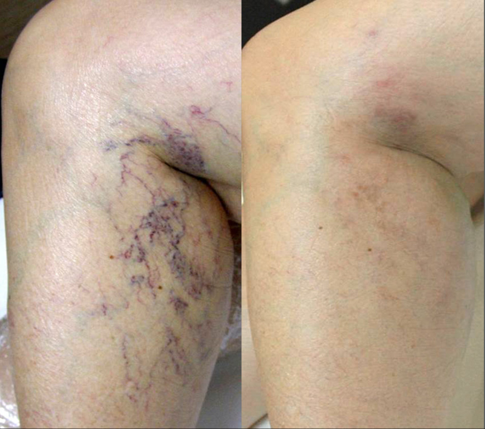 Spider Vein Removal