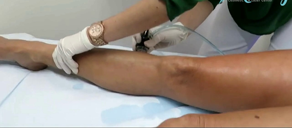 Microdermabrasion On Legs