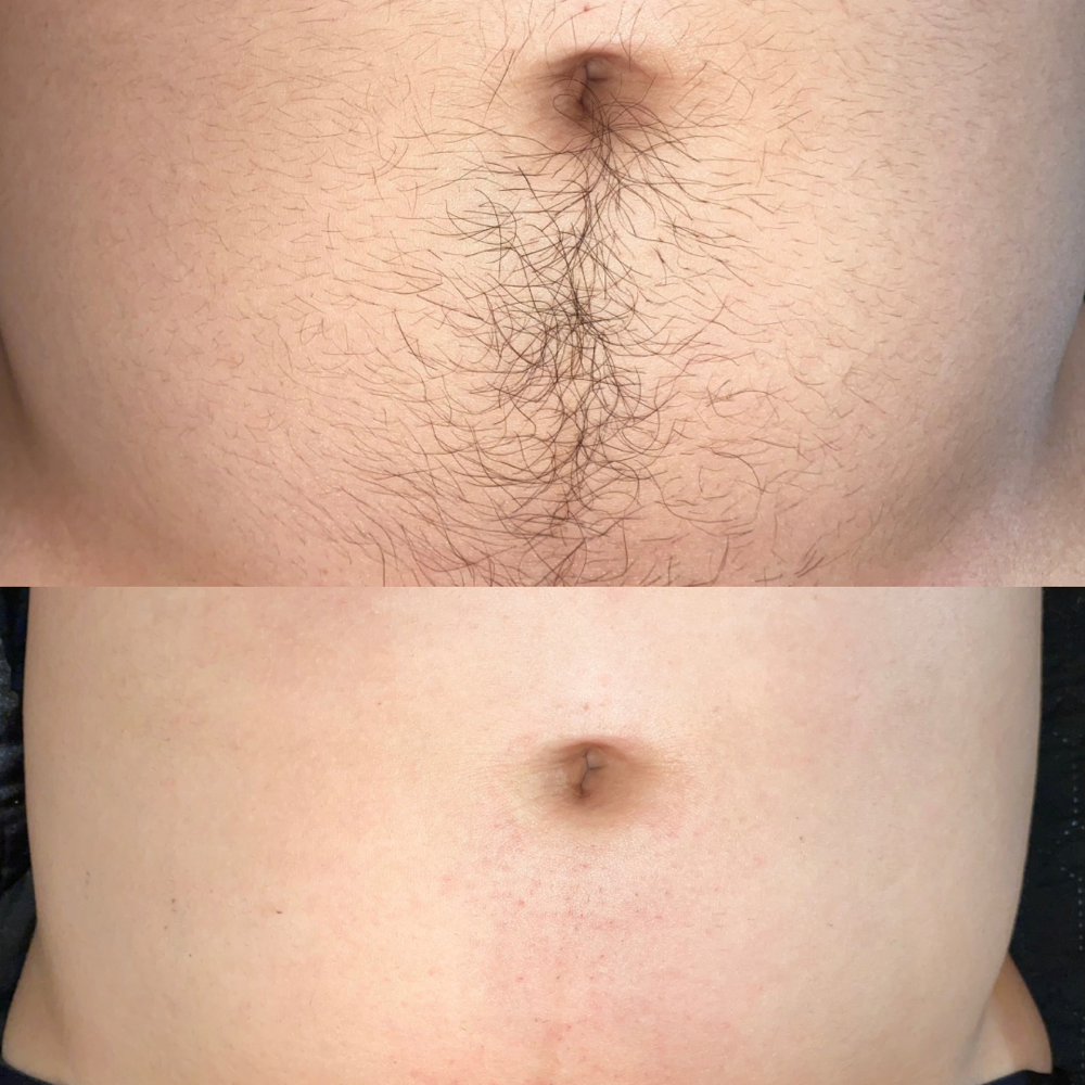 Abdomen (stomach)