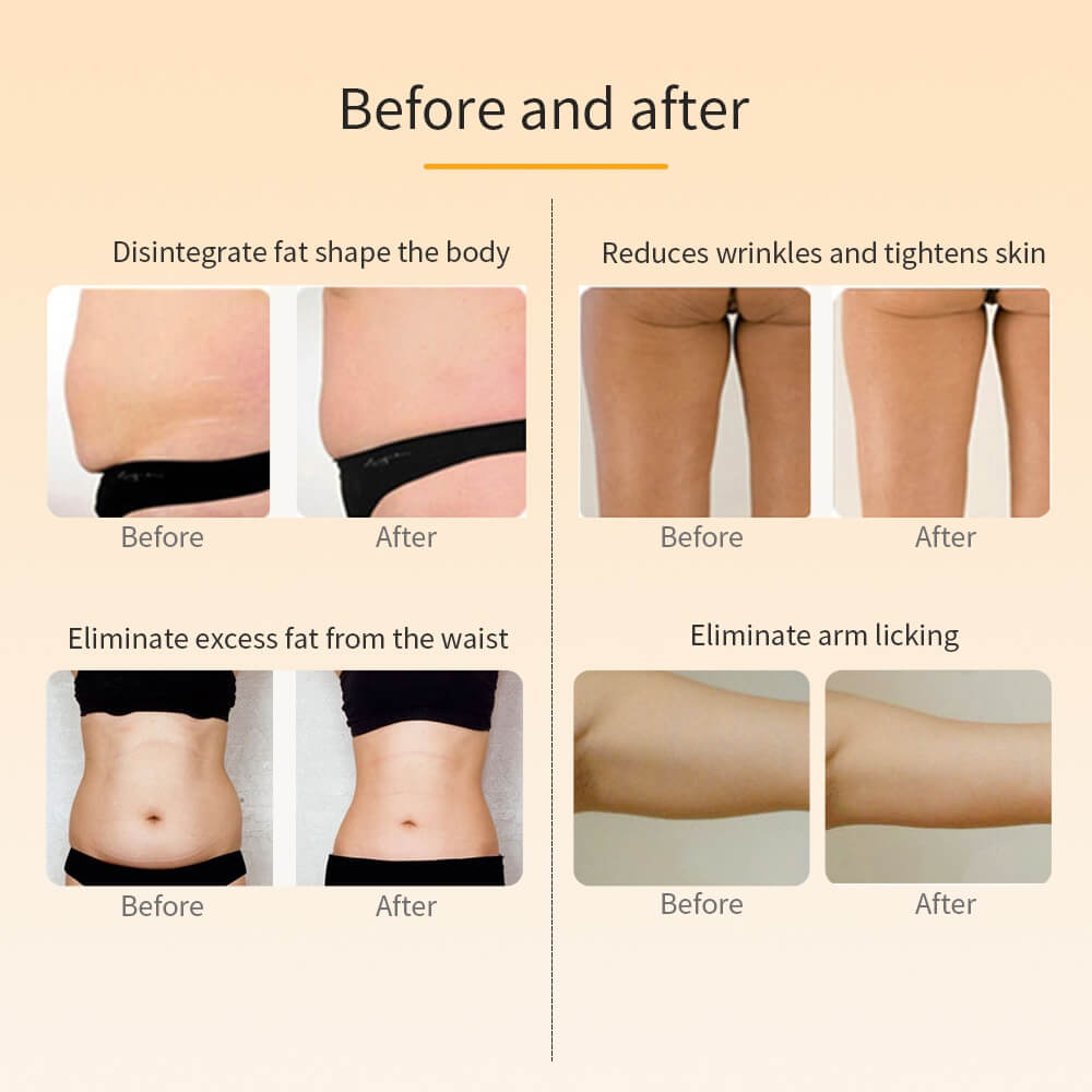 Combo Session (Cavitation + RF)