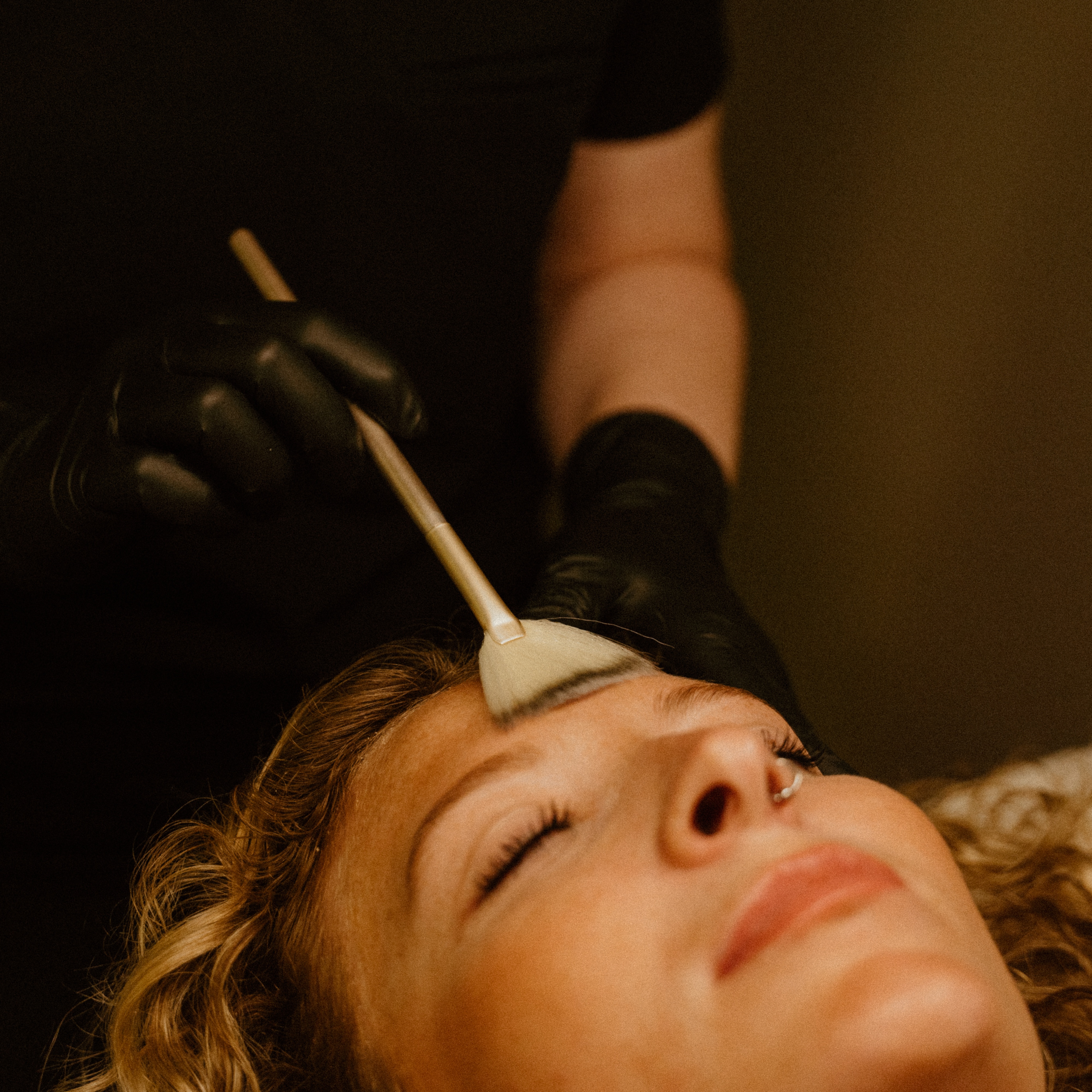 Chemical Peel - Acne at Inspire Aesthetics and Wellness in Saint Augustine, FL