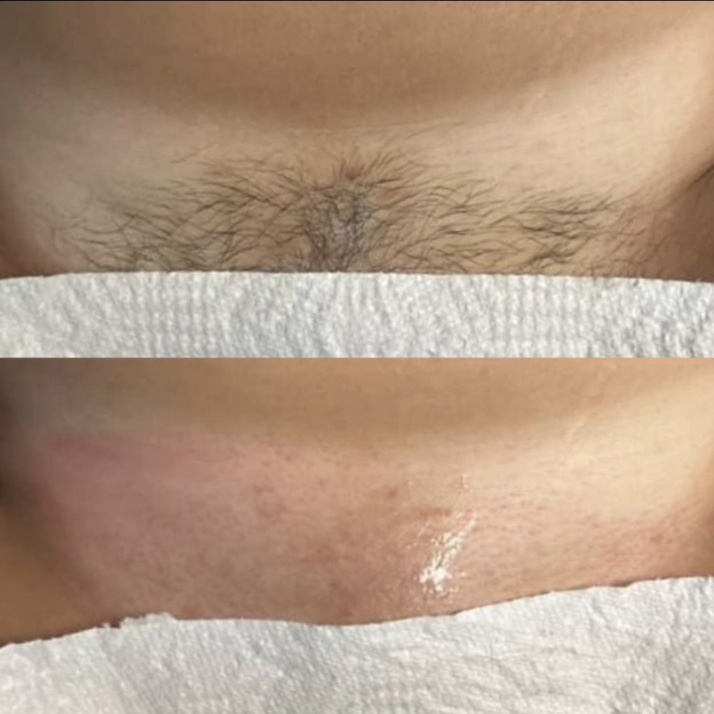 Brazilian(V) Wax