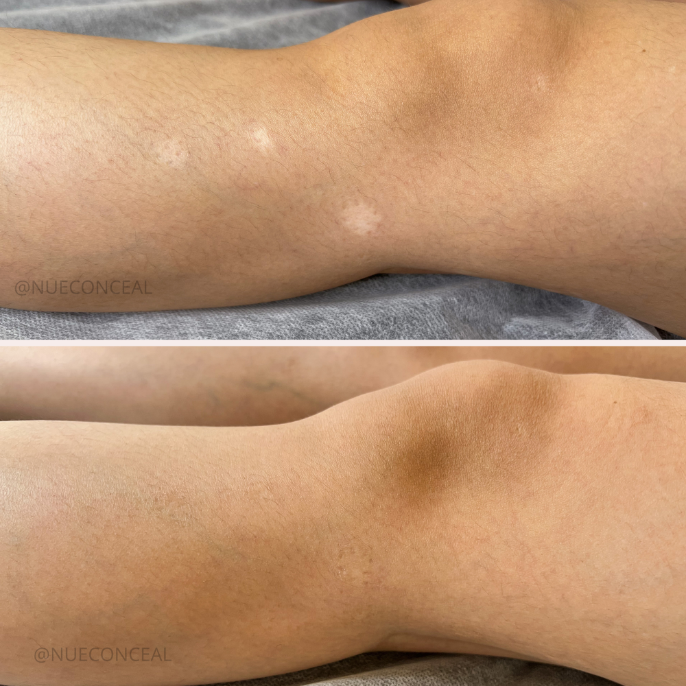 Nue Conceal Scar Or Stretch Mark