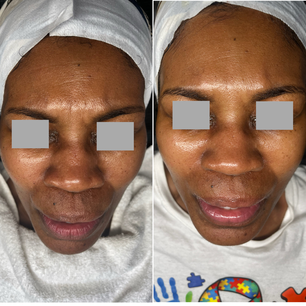Skin Tightening Facial