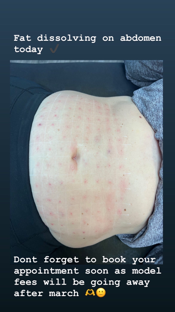 Fat Dissolving Stomach