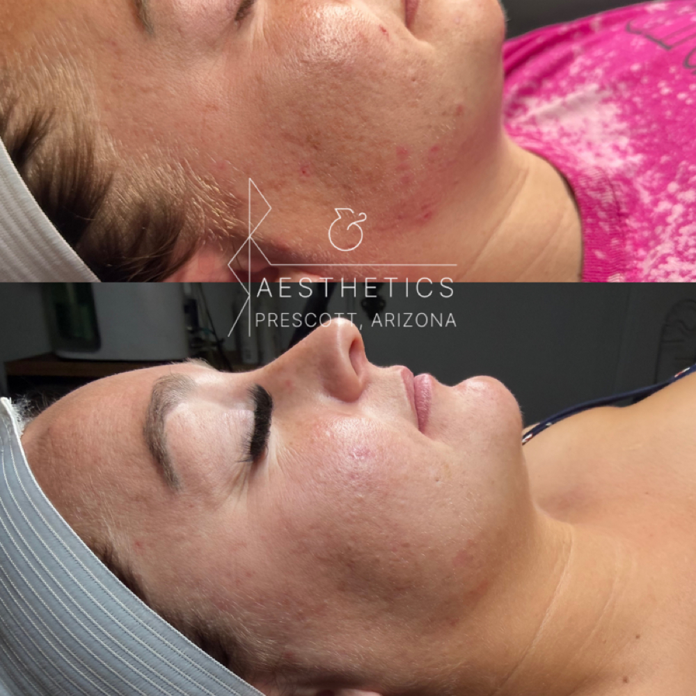 Silver Acne peel (Tier 2) at R&R Aesthetics - Prescott, Arizona in Prescott, AZ