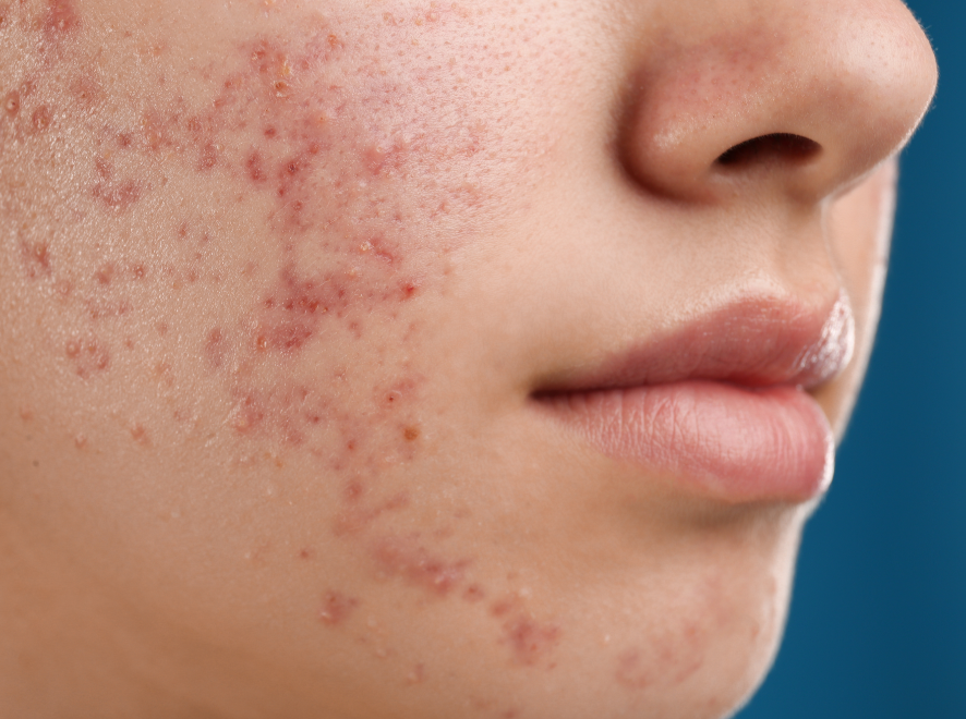 No Zit Sherlock Acne Facial