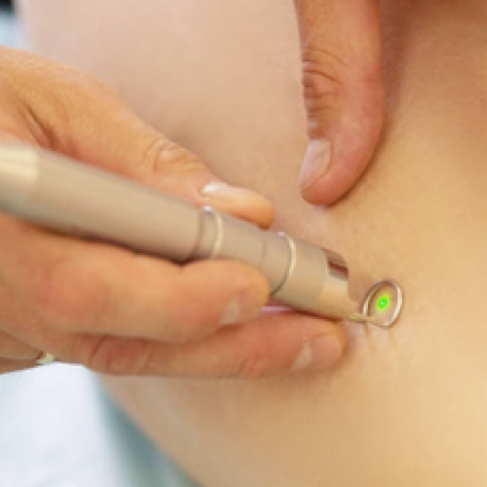 Laser Vein Reduction at Empower Aesthetics in Canyon Lake, TX