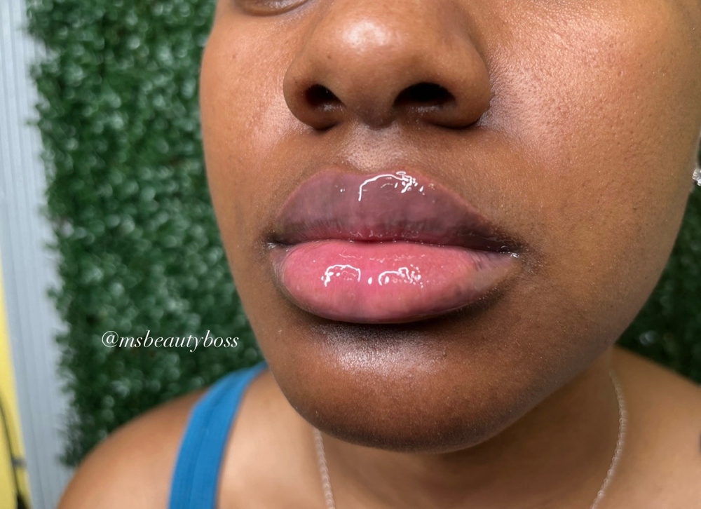 Lip Fillers