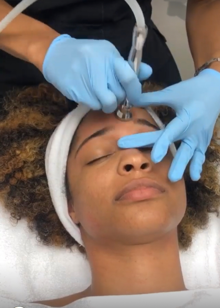 Best Microdermabrasion