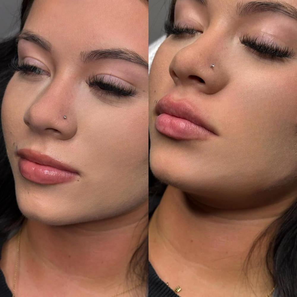 0.7 Syringe, Dermal Filler💉 at AJ Rey Injects in Wolfforth, TX
