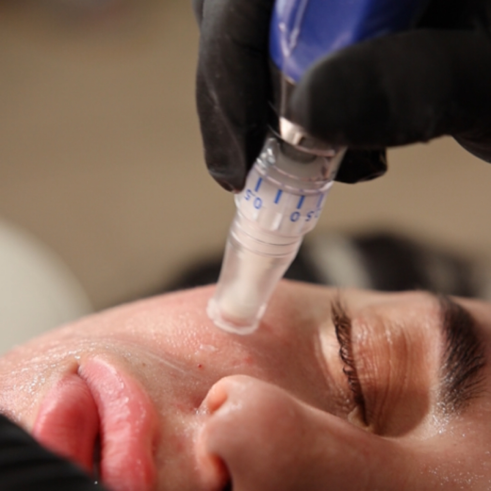 Microneedling with Growth Factors