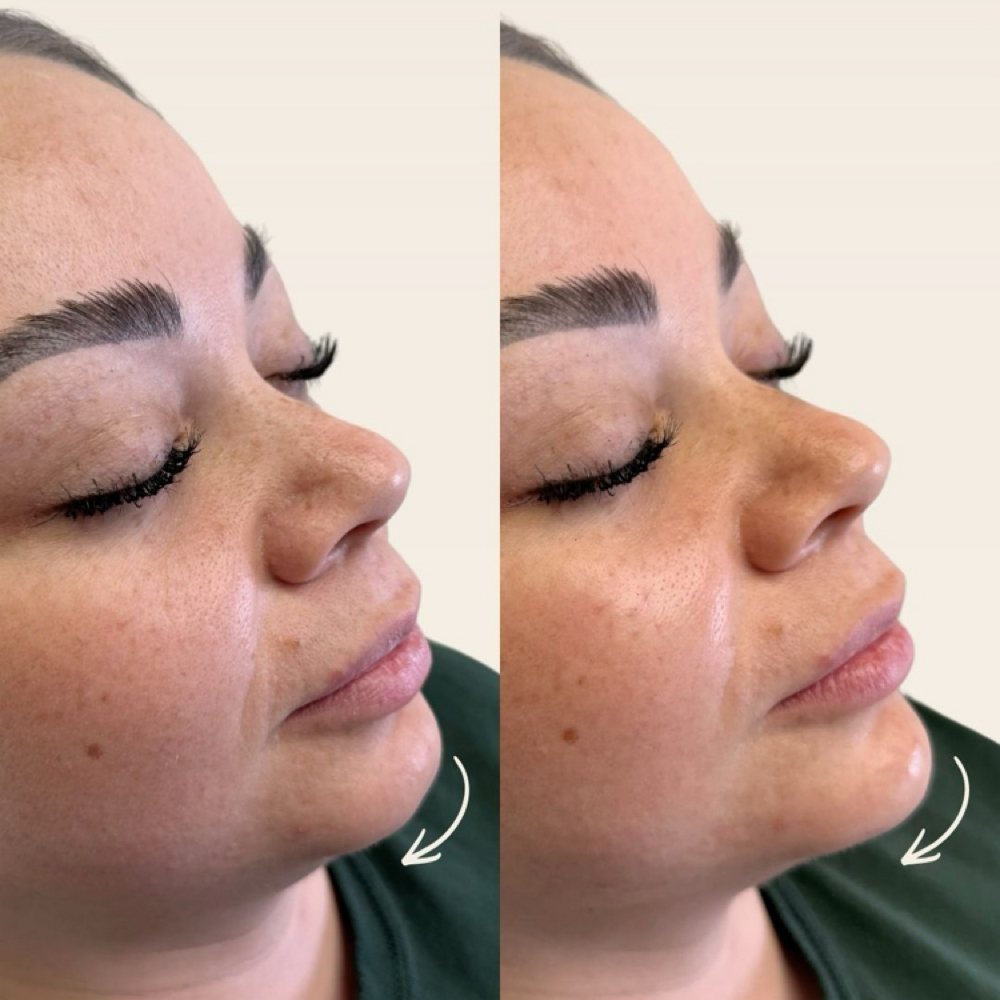 Chin Filler at Aether Aesthetics in Midland, TX