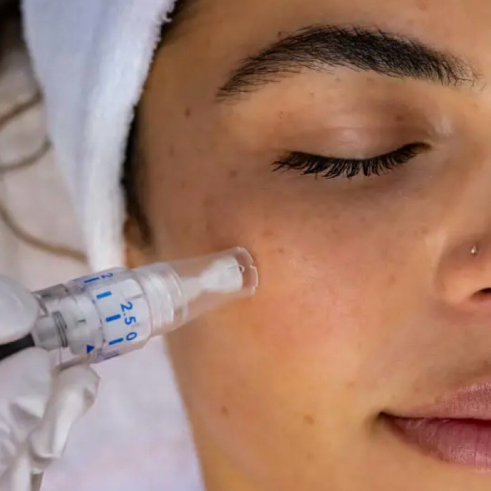 Microneedling with Hyaluronic acid at Luminous Aesthetic Spa in Quincy, MA