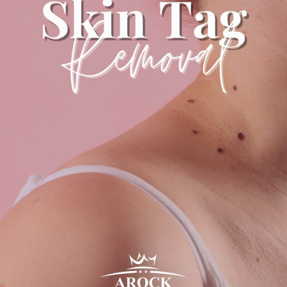 Skin Tag Removal at ARock Beauty & Wellness in San Angelo, TX