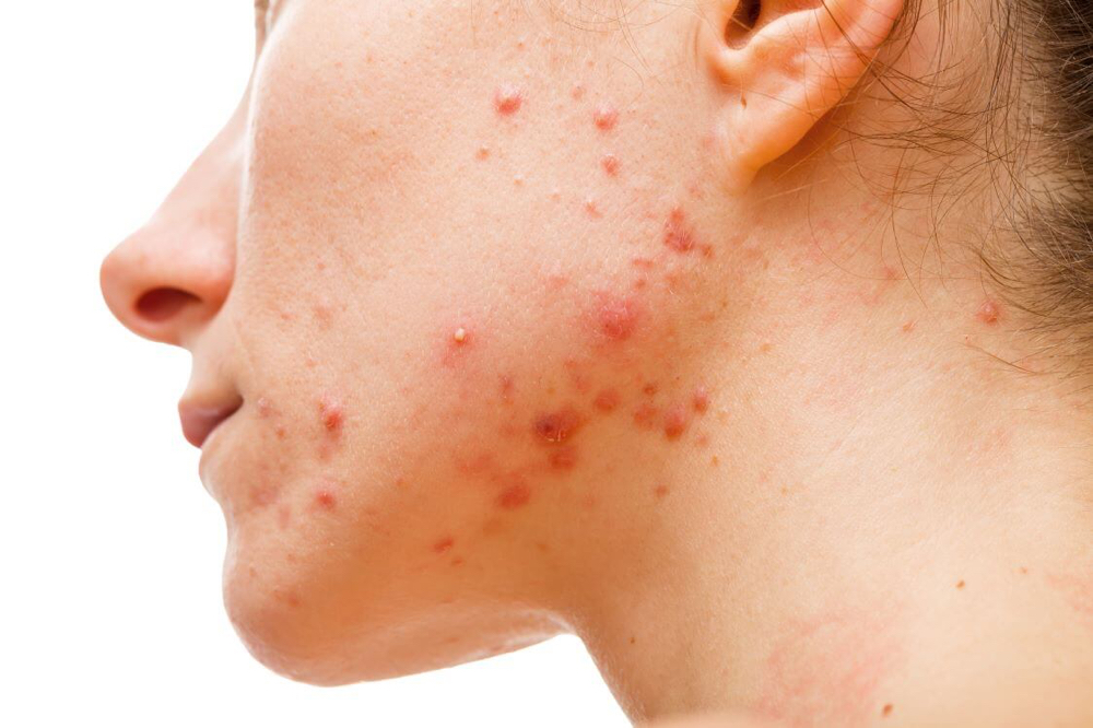 Acne Facial