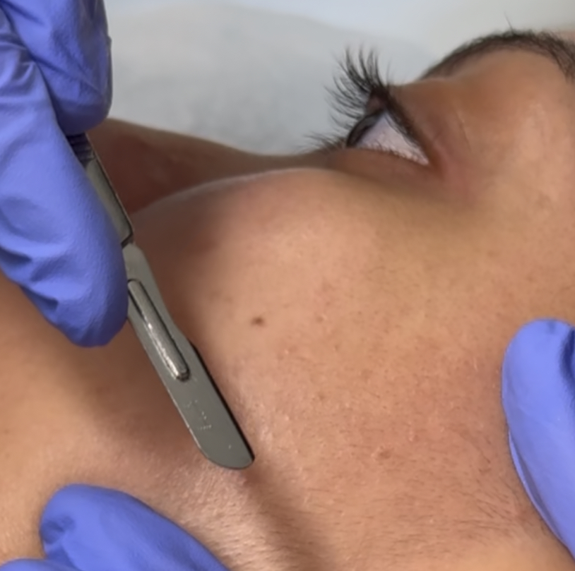 The Bare Facial (Dermaplaning)