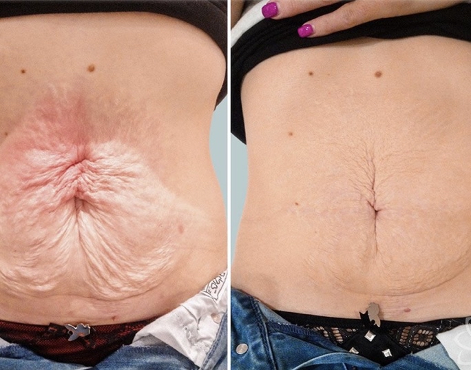 Skin Tightning