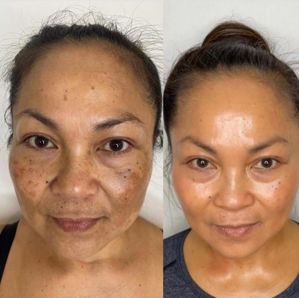 Microneedling Plus Chemical Peel