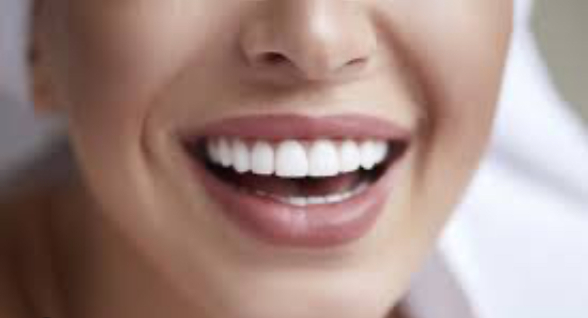 10x10 Composite Veneers