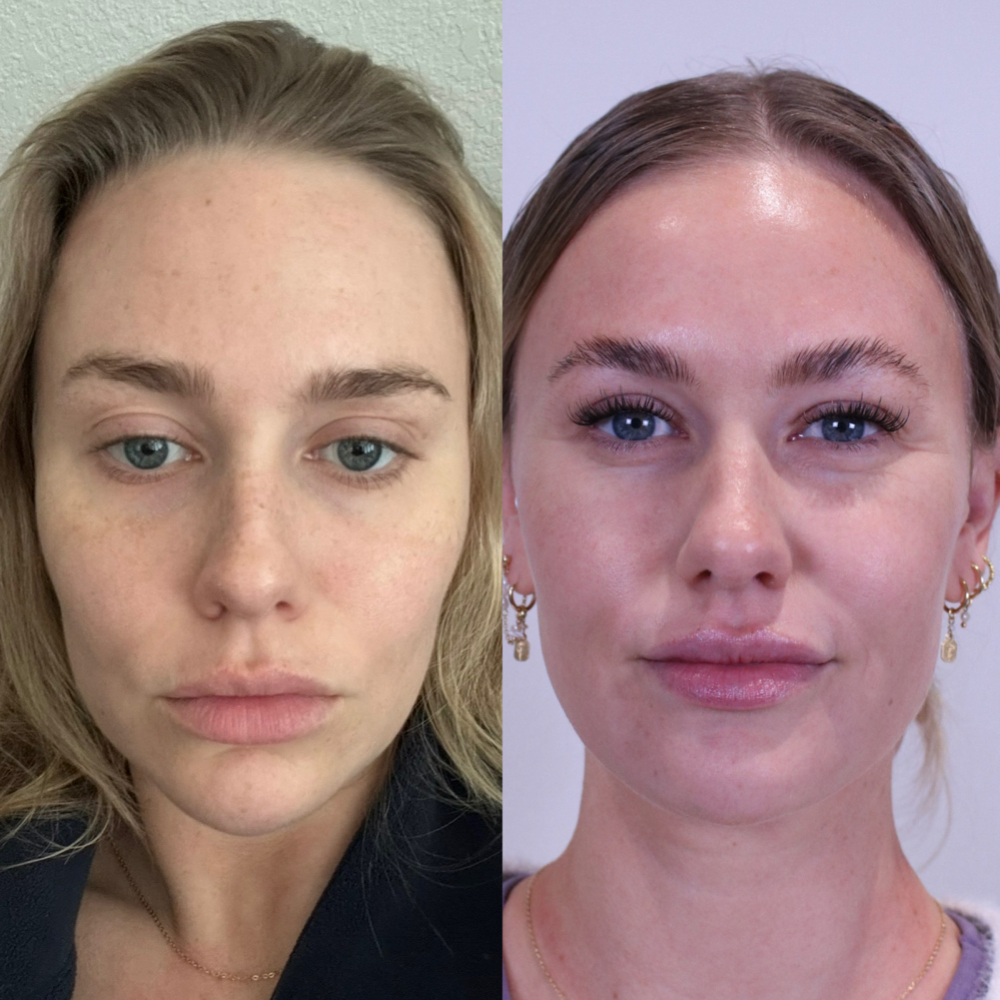 Full facial Balancing at Atelier Aesthetics and Infusions in Dallas, TX