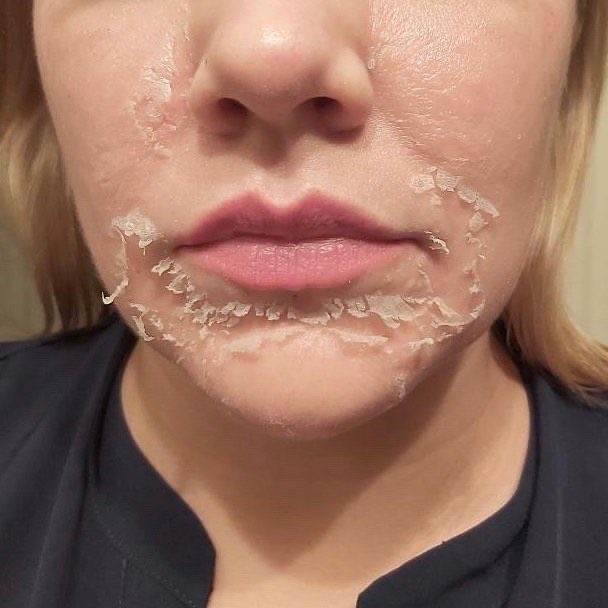 TCA Chemical Peel at Brow And Glow by Kathy in Bellflower, CA