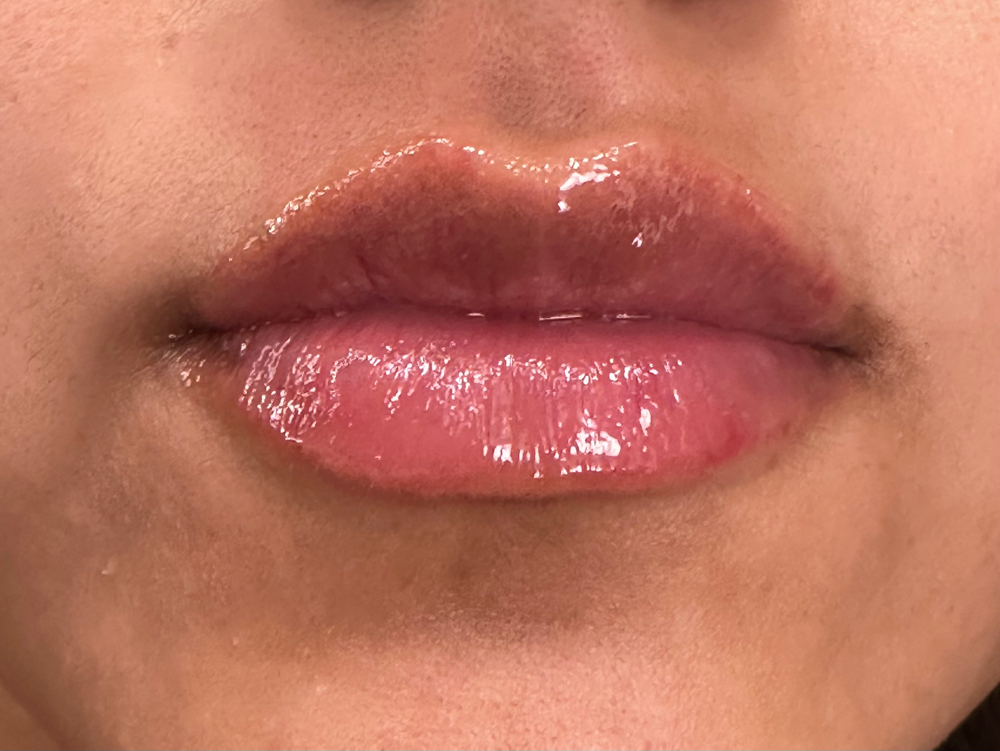Lip Fillers 1/2 Syringe