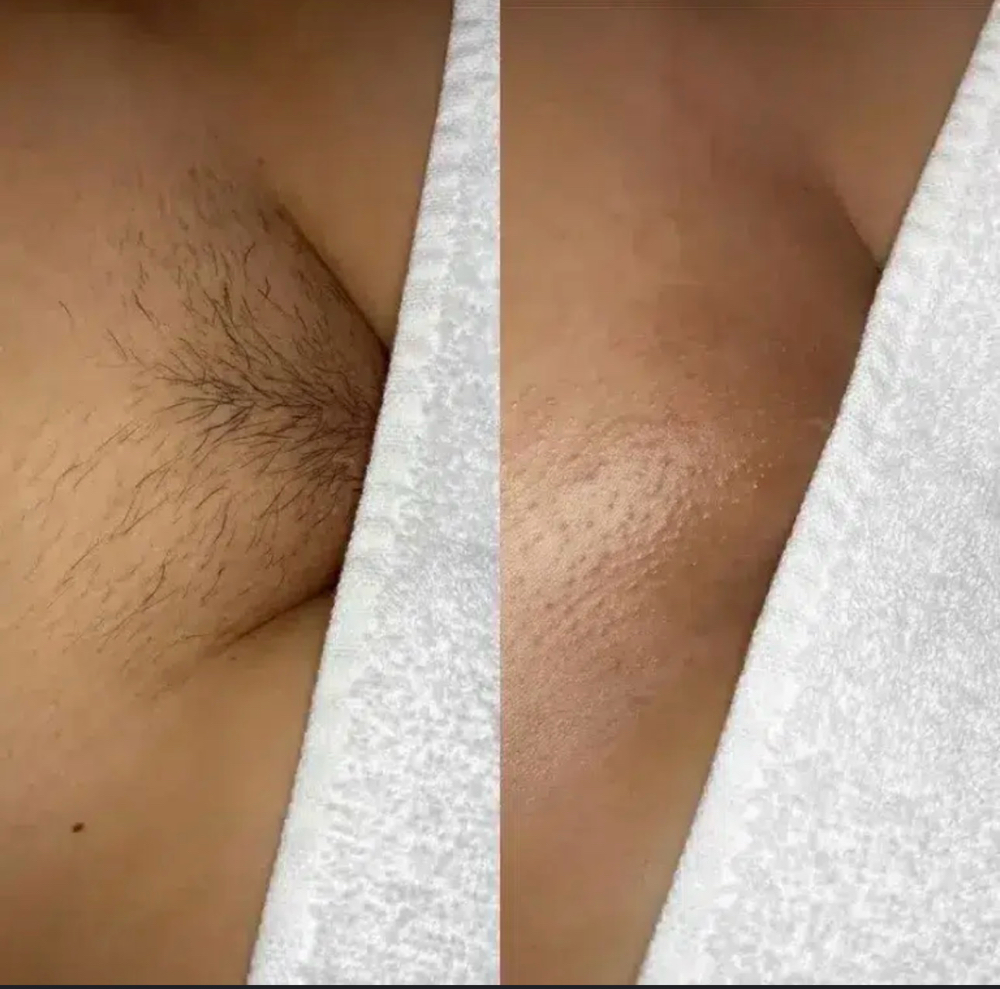 Brazilian Wax