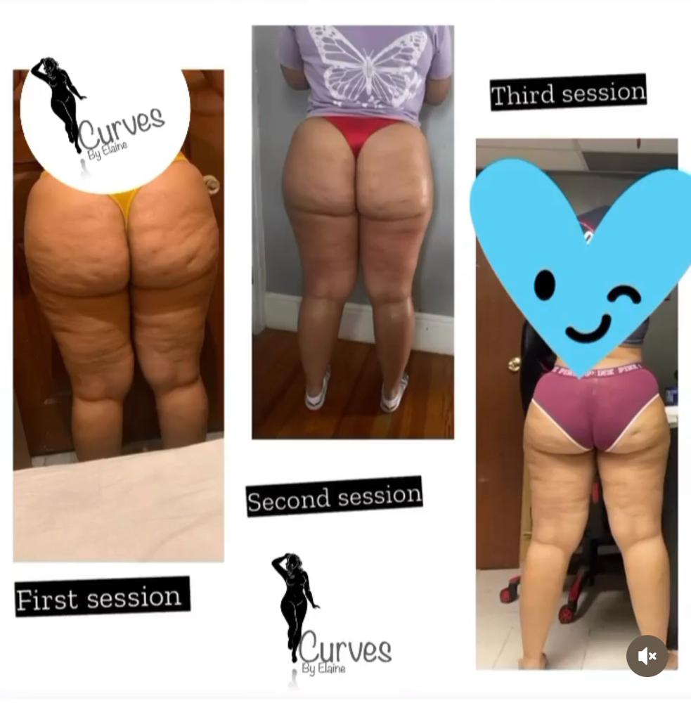 cellulite reduction
