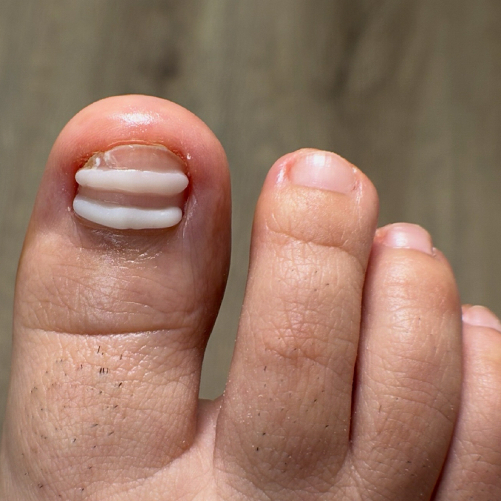 Tratamiento De Uña Enterrada I at Pure Nail Studio in Port Hueneme, CA