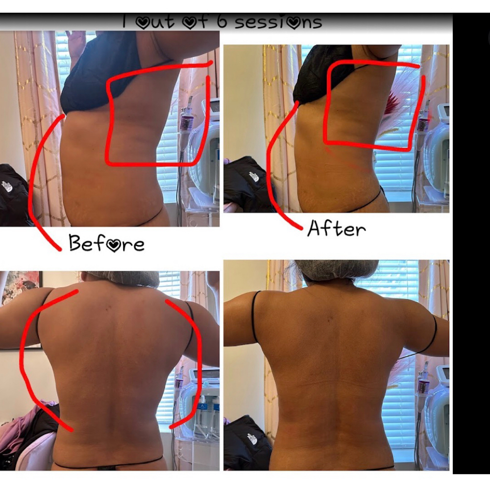 Back fat & bra bulge at Silhouette Body Sculpting LLC in St. Peter’s, MO