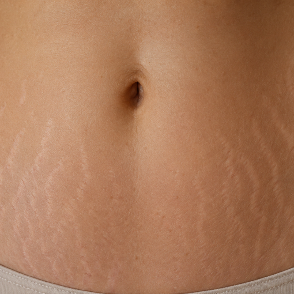 Stretch Mark Revision/ Camouflage at Restore & Transform Ink in Bonita Springs, FL