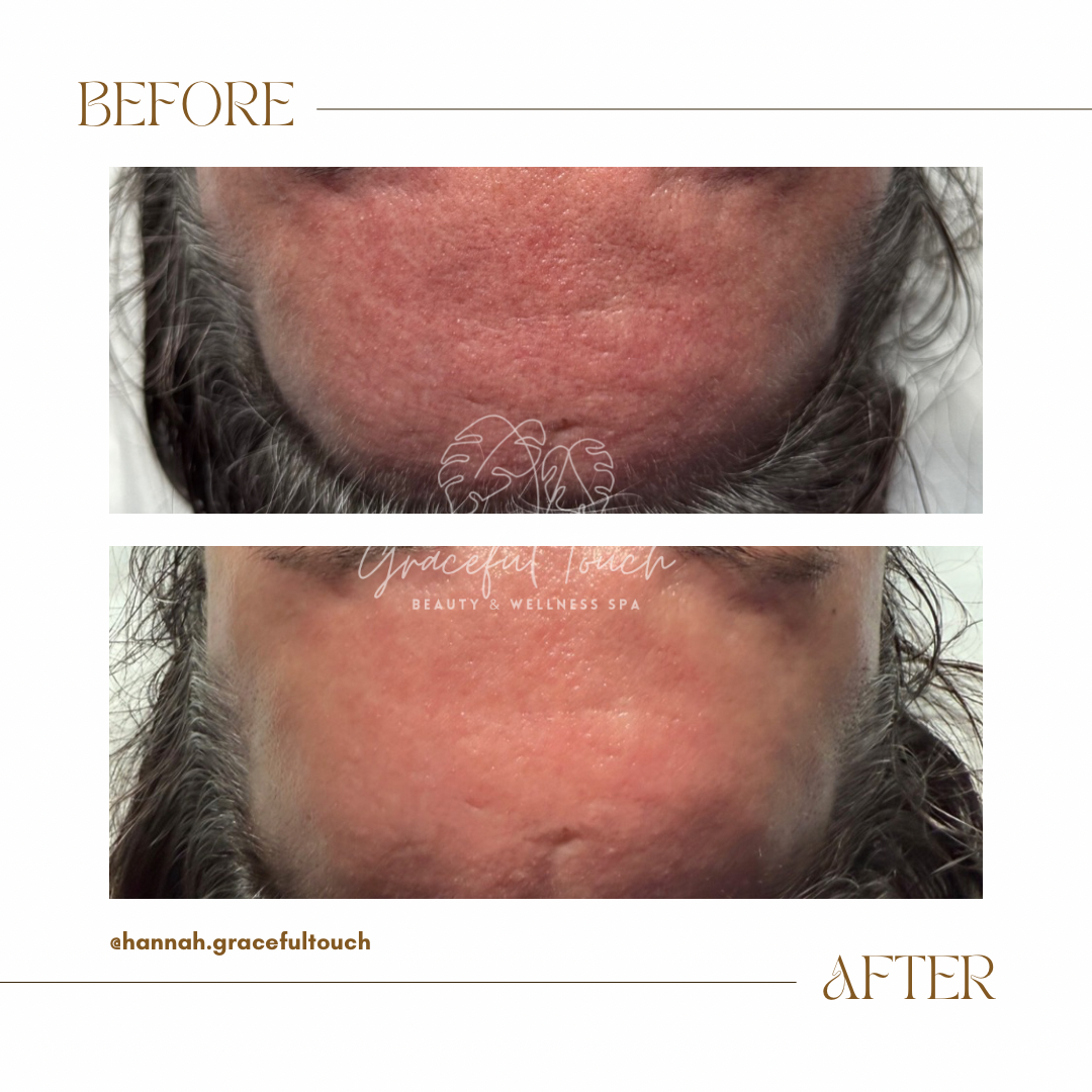 Graceful Barrier Restoration